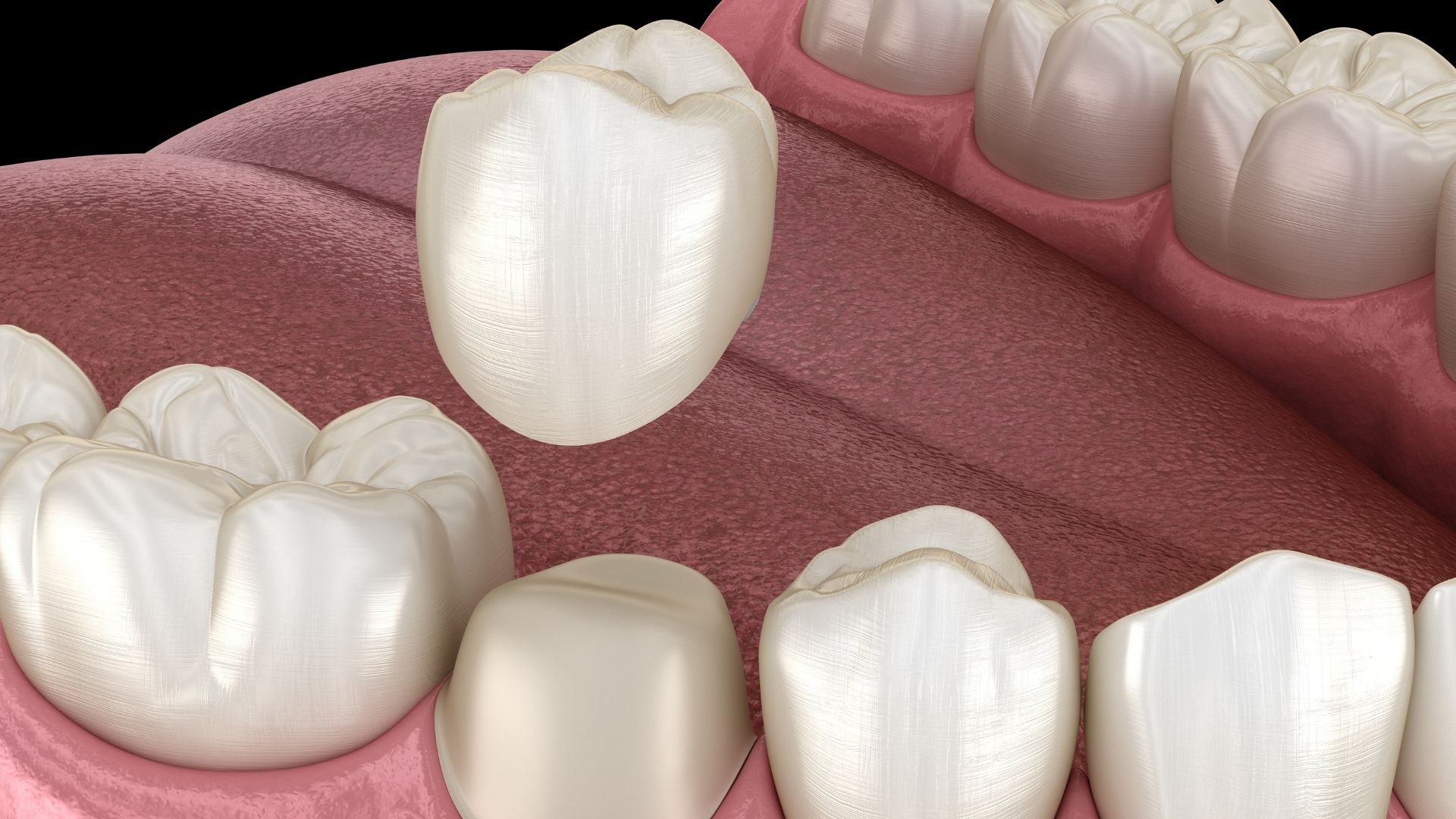 Dental Crowns and Bridges- Dentistry On Main (1920 × 1080 px)